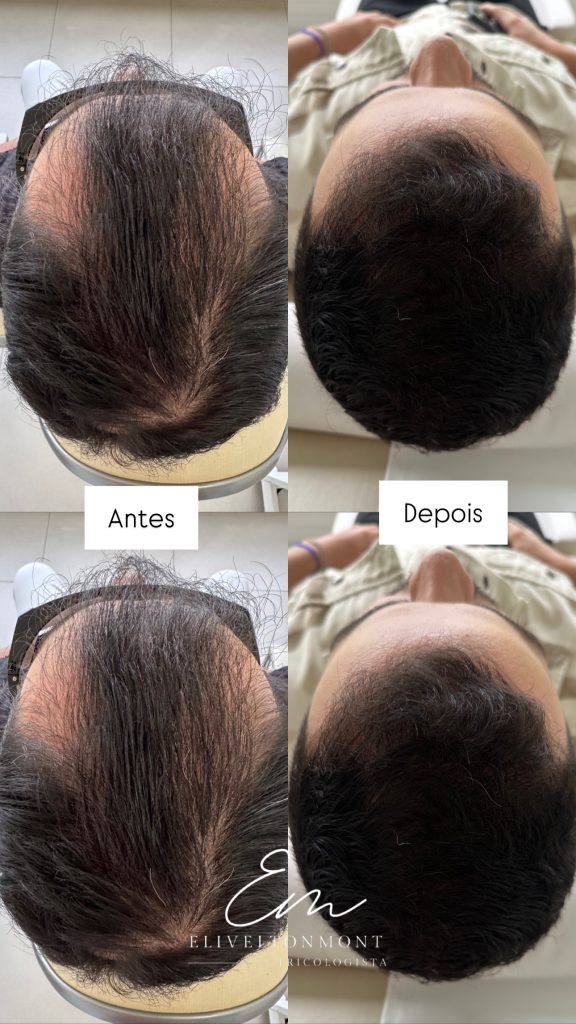 Antes e Depois - Tratamento capilar resultado 2 - Tricologista Moema SP