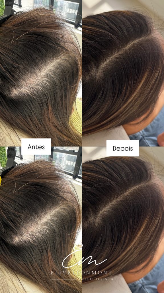 Antes e Depois - Tratamento capilar resultado 4 - Tricologista Moema SP