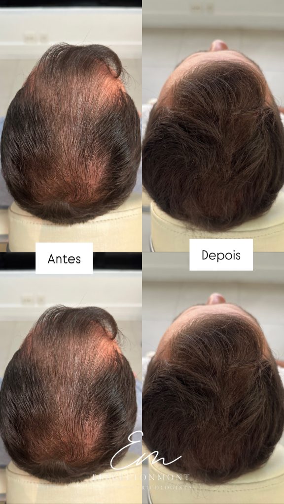 Antes e Depois - Tratamento capilar resultado 1 - Tricologista Moema SP