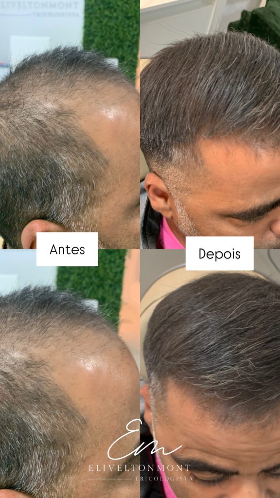 Antes e Depois - Tratamento capilar resultado 5 - Tricologista Moema SP